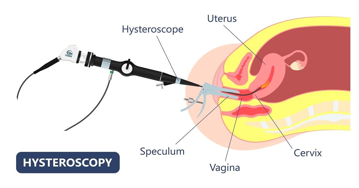 Expert Hysteroscopy in IVF | Advance Fertility & Gynecology Centre