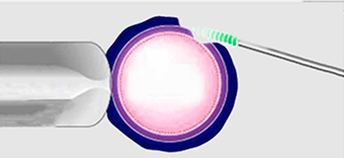 Enhance IVF Success with Laser Hatching | Advanced Fertility Centre