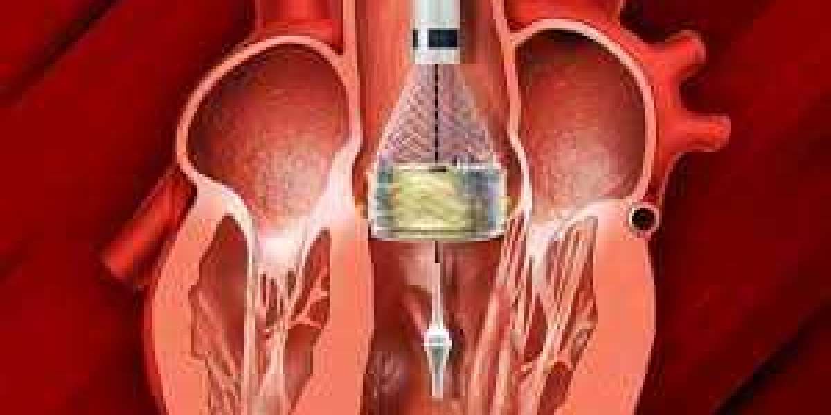 A New Lease on Life: Exploring TAVI for Advanced Aortic Stenosis in Jaipur