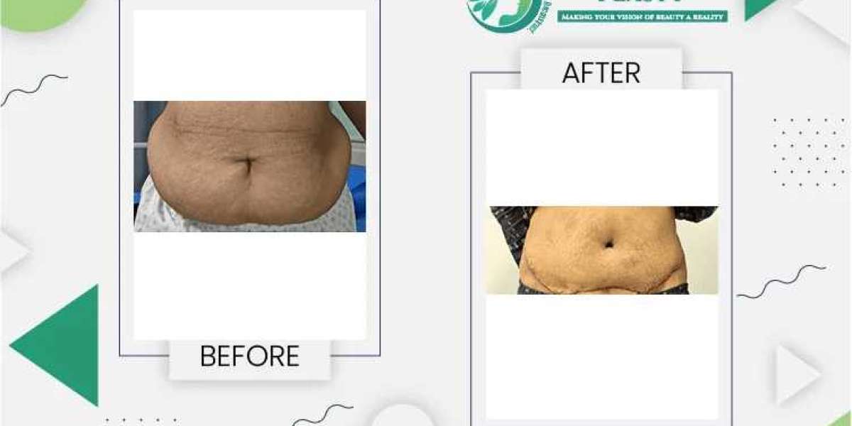 Tummy Tuck Surgery in Lahore: What to Expect and Cost Insights