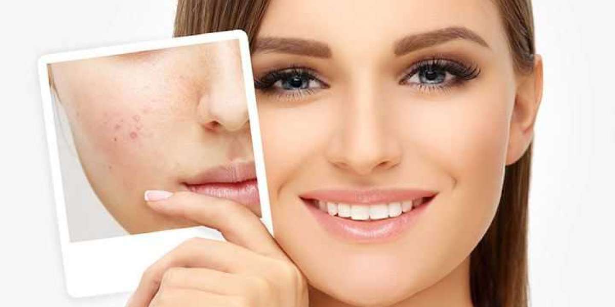 How Esthetics By Monica Customizes Acne Treatments